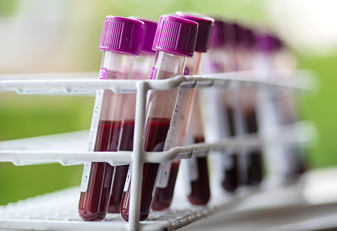 Dekorativt billede af fyldte reagensglas med blodprøver