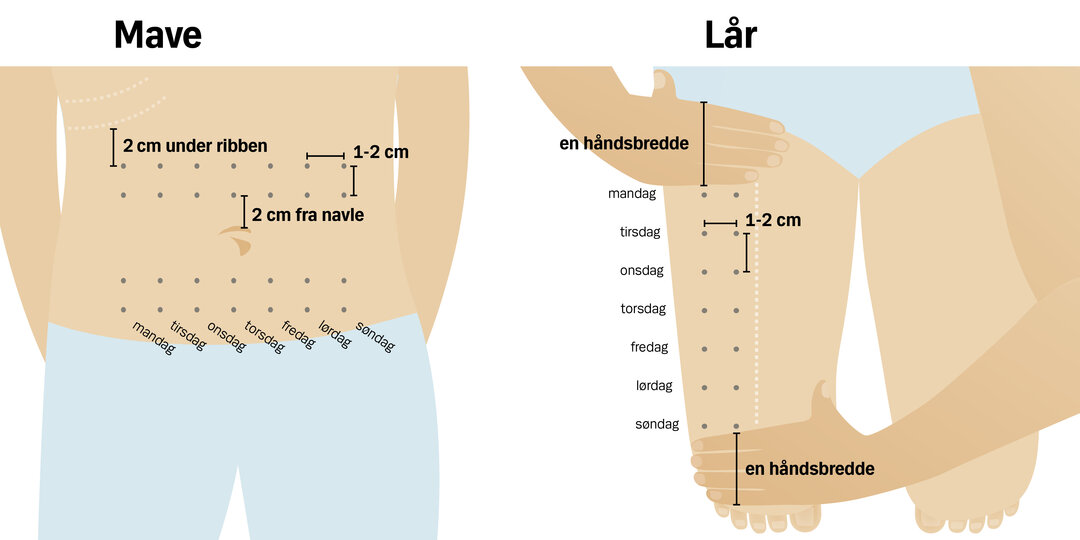 Illustrationer viser, hvordan man kan fordele indsprøjtninger med insulin eller GLP-1 i mave og lår.