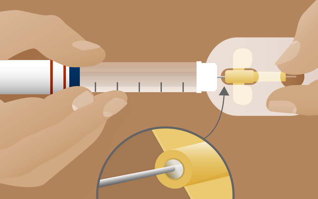 Illustration af hvordan insulin med pen sprøjtes ind i insuflonet